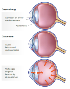 afbeelding gezond oog en oog met glaucoom